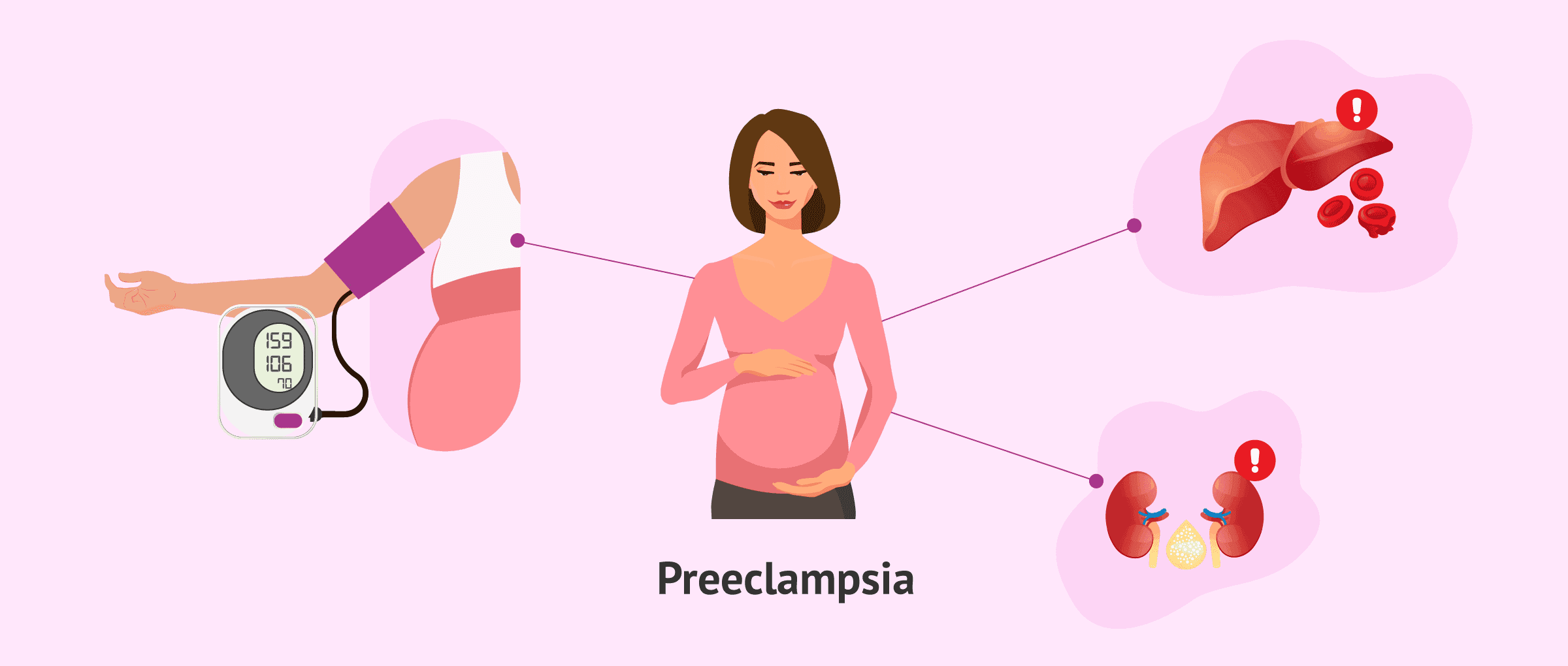 Managing Severe Preeclampsia: A Comprehensive Guide