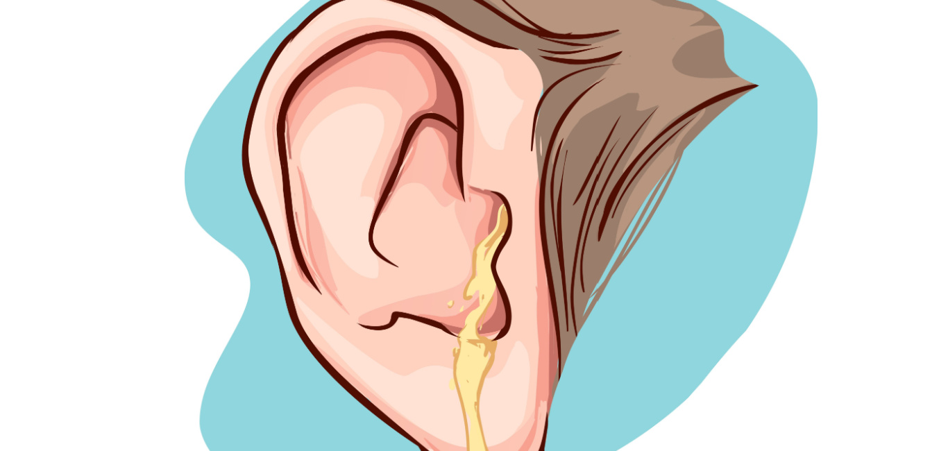 Understanding Otorrhea: Causes, Diagnosis, and Management