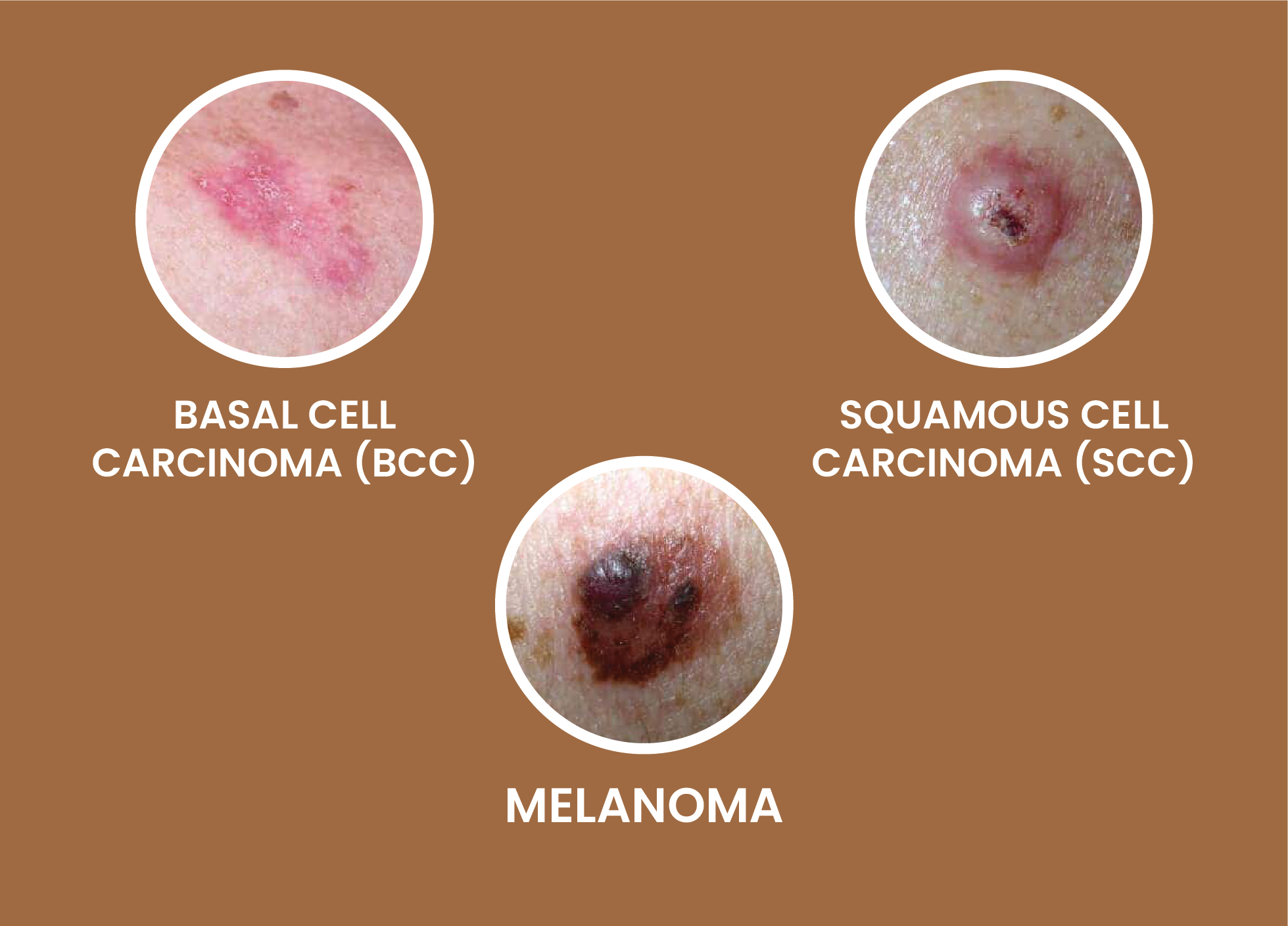 The 3 Major Skin Cancers You Should Know About: Symptoms, Risks, and Treatments
